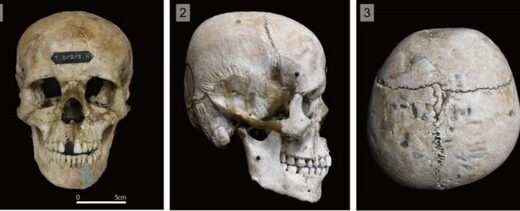 Click to enlarge deformed skull