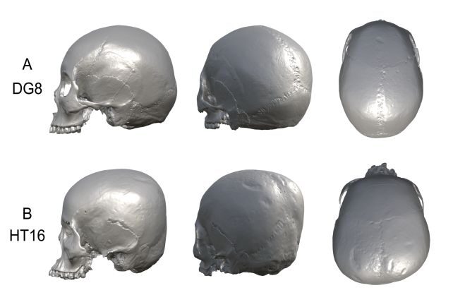 Click to enlarge deformed skull