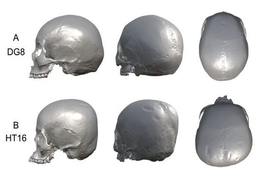 Click to enlarge deformed skull