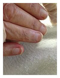Typical ground glass appearance of Terry’s nails.