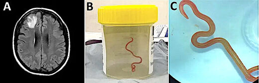 Click to enlarge Roundworm