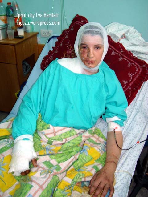 palestinian burnt