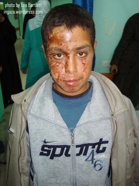 phosphorous burns