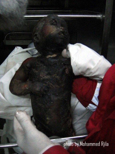 phosphorous burns