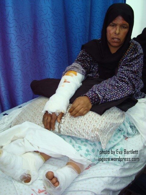 phosphorous burns