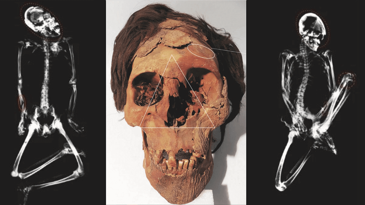 skull with head trauma