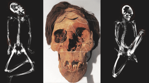 skull with head trauma