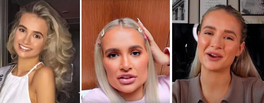 instagram face plastic surgery gen alpha