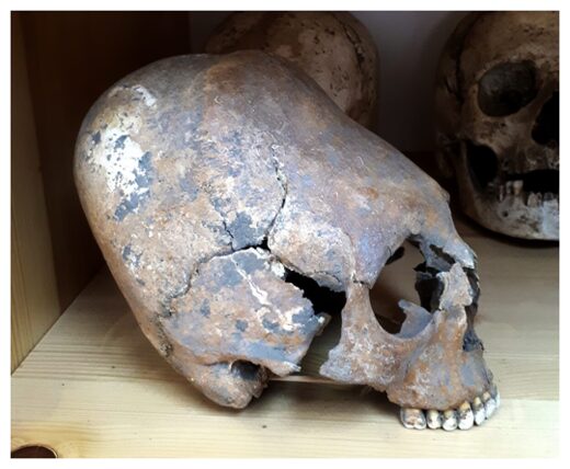 Click to enlarge Deformed skull dated to the 4th century CE