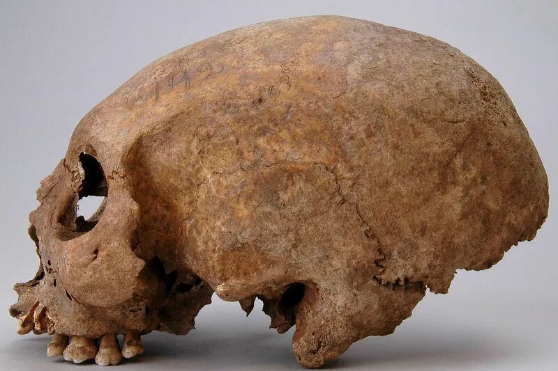 Click to enlarge cranial deformation viking