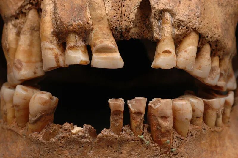 Click to enlarge cranial deformation viking