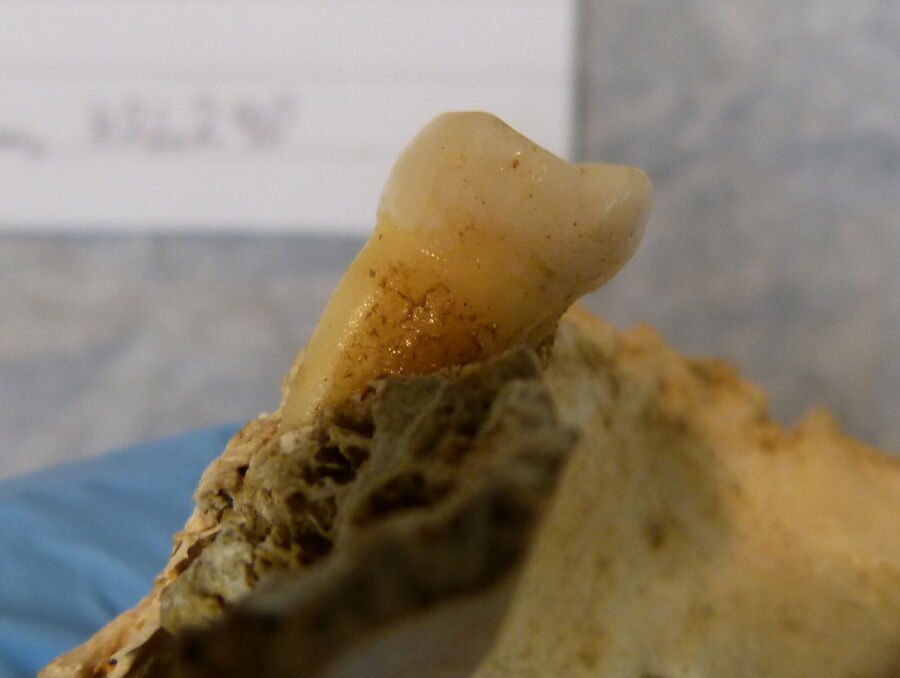 Click to enlarge tooth