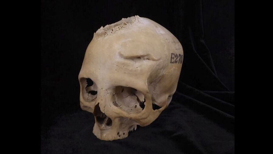egyptian skull ancient tumor surgery brain cancer