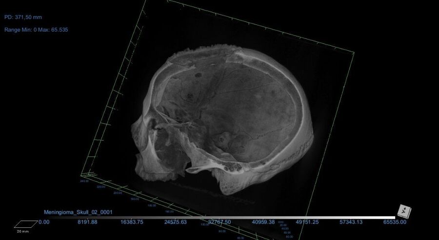 ancient egyptian skull brain surgery cancer
