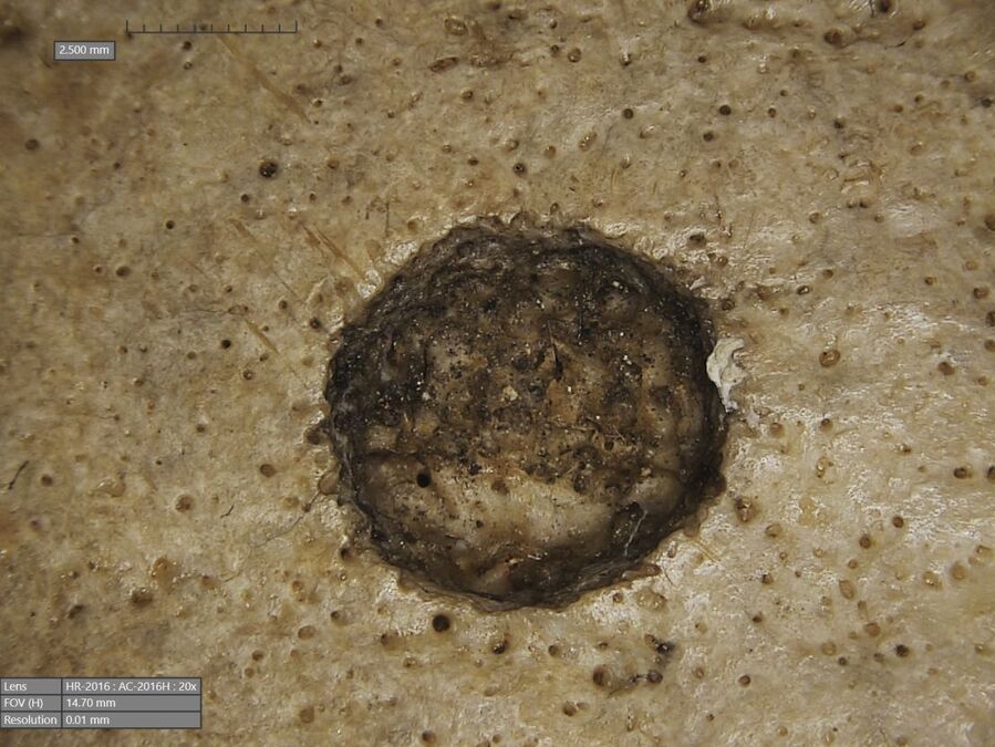 ancient egyptian skull cancer lesion surgery
