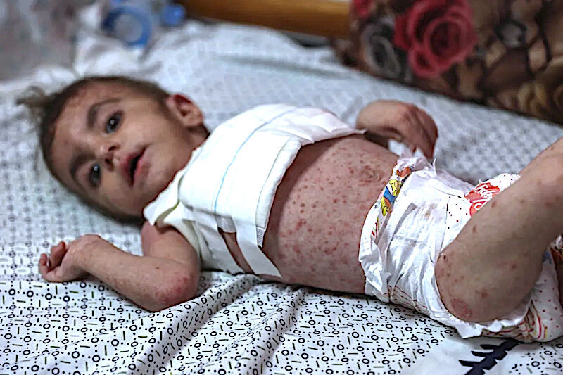disease Gaza
