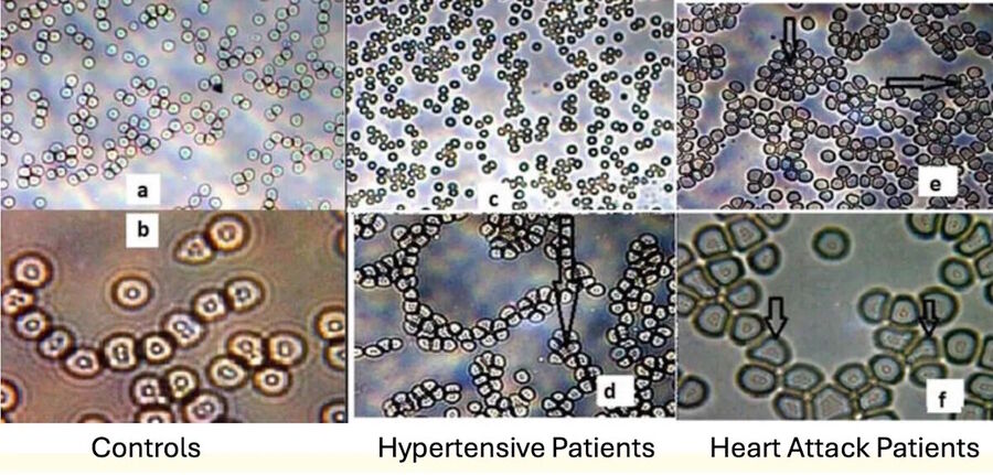 cardiovascular diseas blood slides