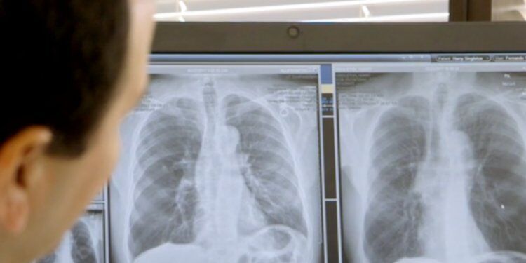 X-Ray lungs
