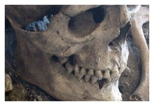 Skeleton with evidence of bladed weapon injuries.
