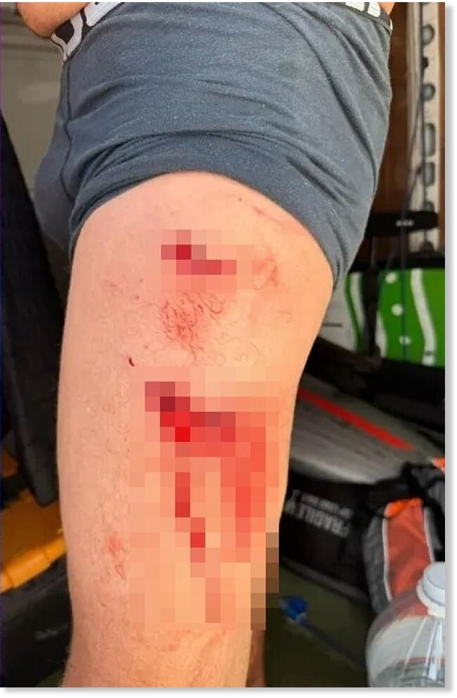 Click to enlarge Although he was able to fight off the shark, the man sustained two gruesome bites just below his knees