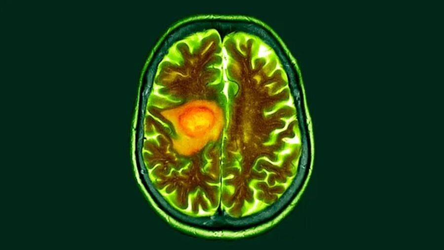 brain cancer cat scan