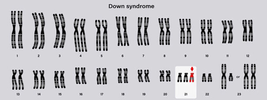 down syndrome karyotype Autosomal abnormalities