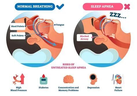 Click to enlarge sleep apnea