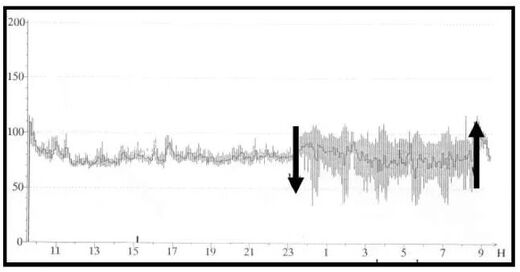 Click to enlarge pathological HRV