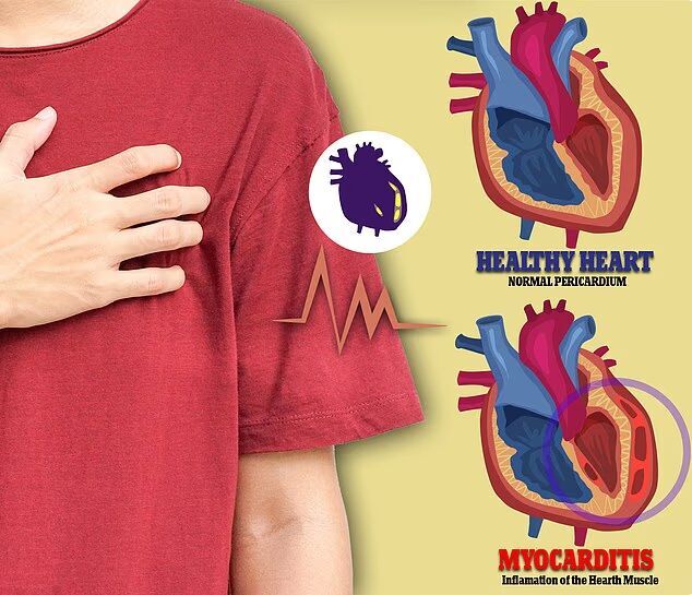 Click to enlarge myocarditis warning poster