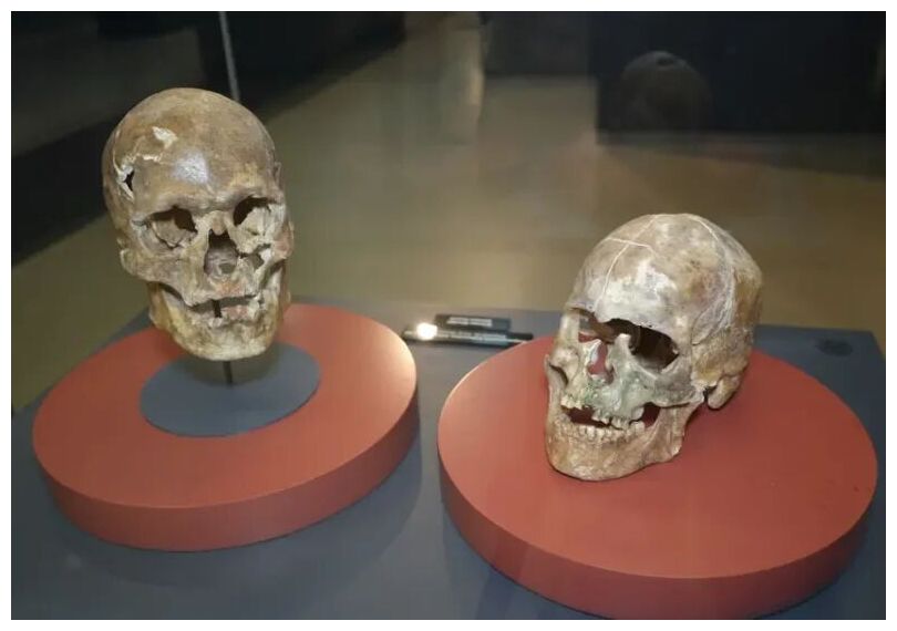 Skull Surgery