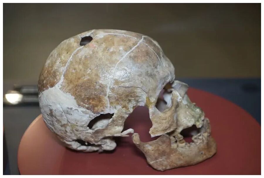 Skull Surgery