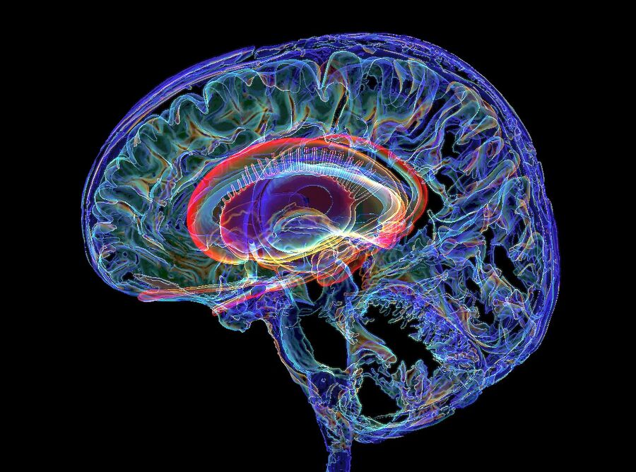 Brain 3D MRI