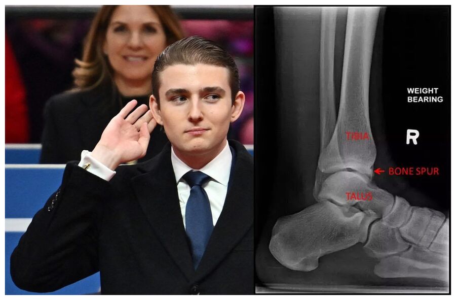 Bone Spurs