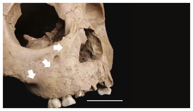 Skull Lesions