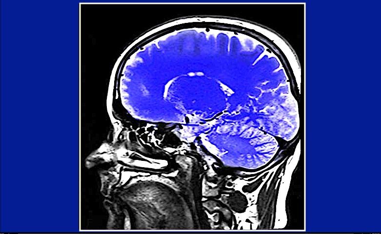Click to enlarge brain scan
