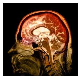 Mentl Disorders