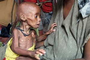 Click to enlarge malnourished child