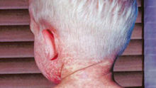 measles
