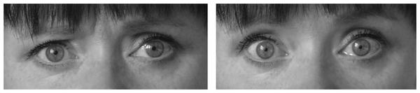 Hypnotically Induced Stare