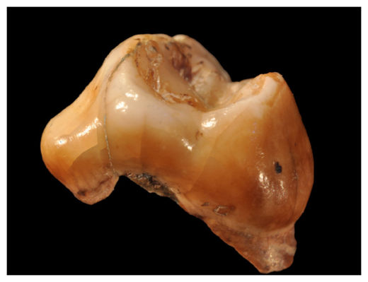 Molar Tooth