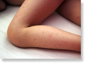 Chickenpox Vaccine