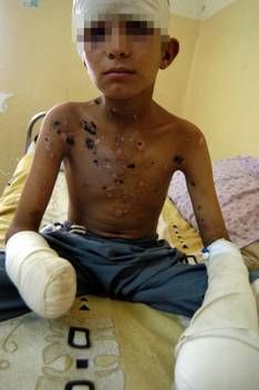 Click to enlarge Ahmed Kamel, 12-year old Iraqi, victim of US cluster bomb