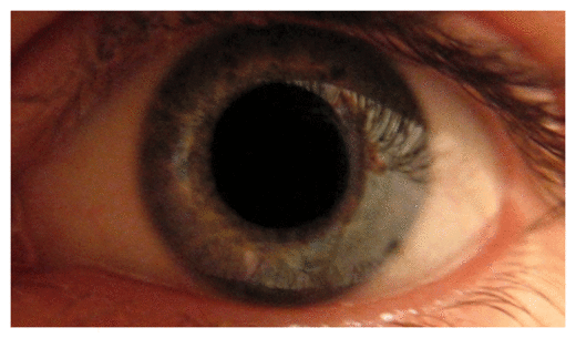 Dilated Eyes