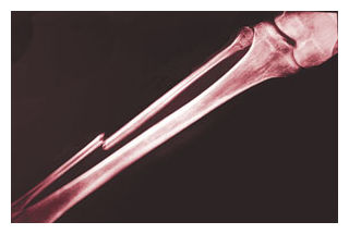 Broken Bone