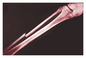 Broken Bone