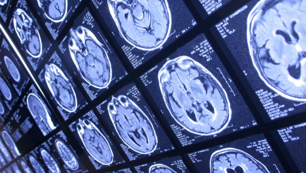 Alzheimer y el Parkinson