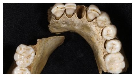 Neanderthal Teeth