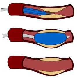 Click to enlarge stent