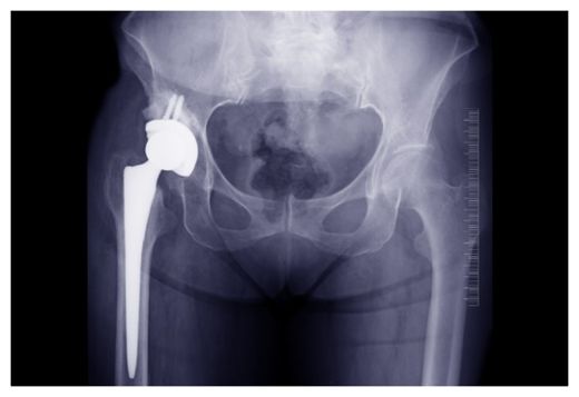X-Ray