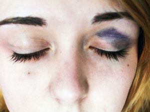 woman with bruised face